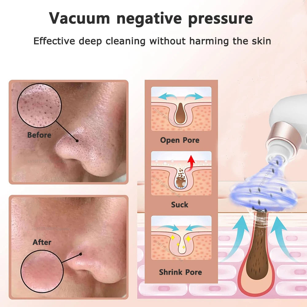 Blackhead Remover Vacuum — Electric Pore Cleaner USB Rechargeable Water Cycle Face Cleanser